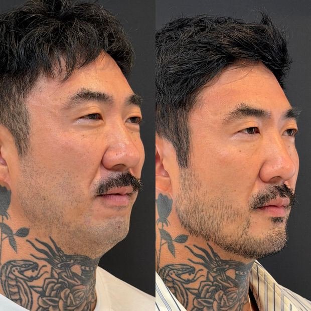 Harmonização facial, antes e depois, vista de perfil