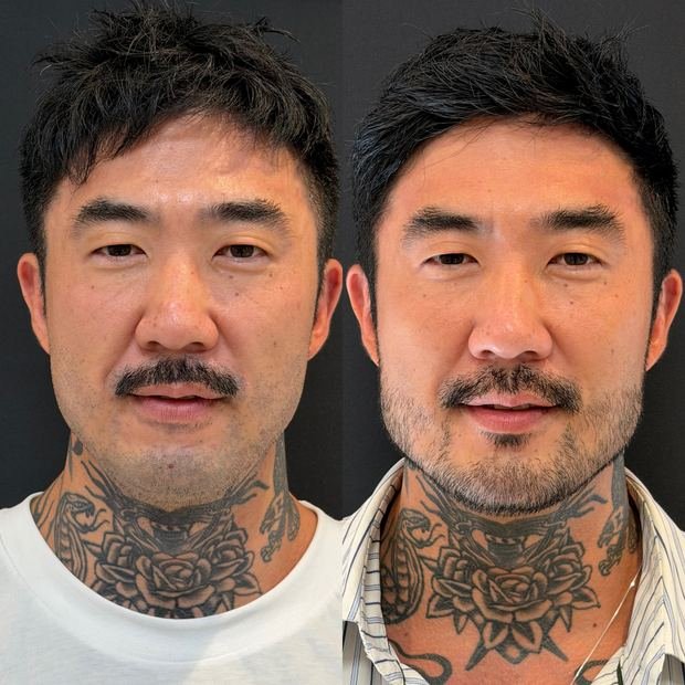 Harmonização facial, antes e depois