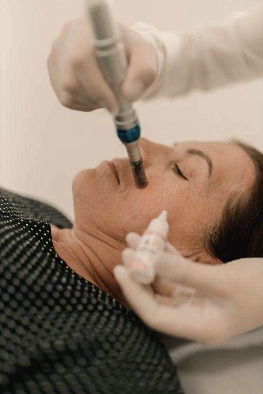 Microagulhamento facial