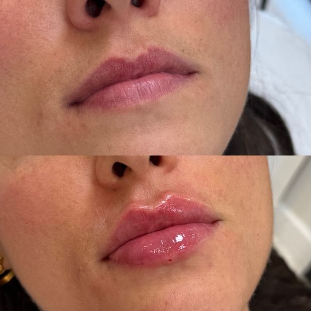 Preenchimento labial, antes e depois