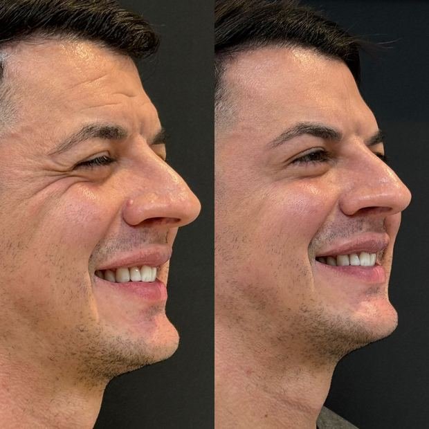 Toxina botulínica, antes e depois, vista de perfil