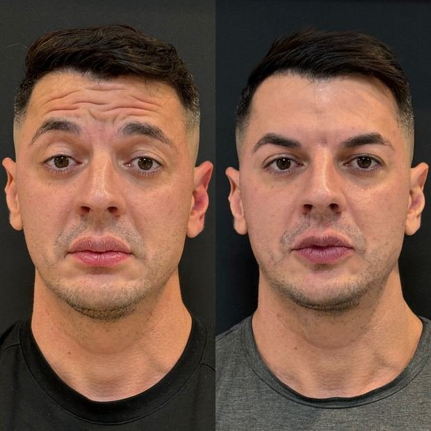 Toxina botulínica, antes e depois